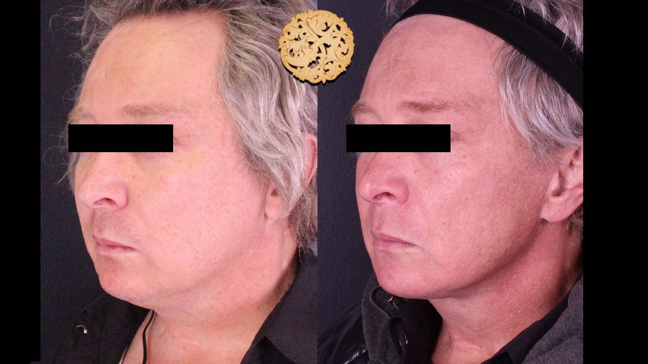 Facelift Neck Lift Before & After