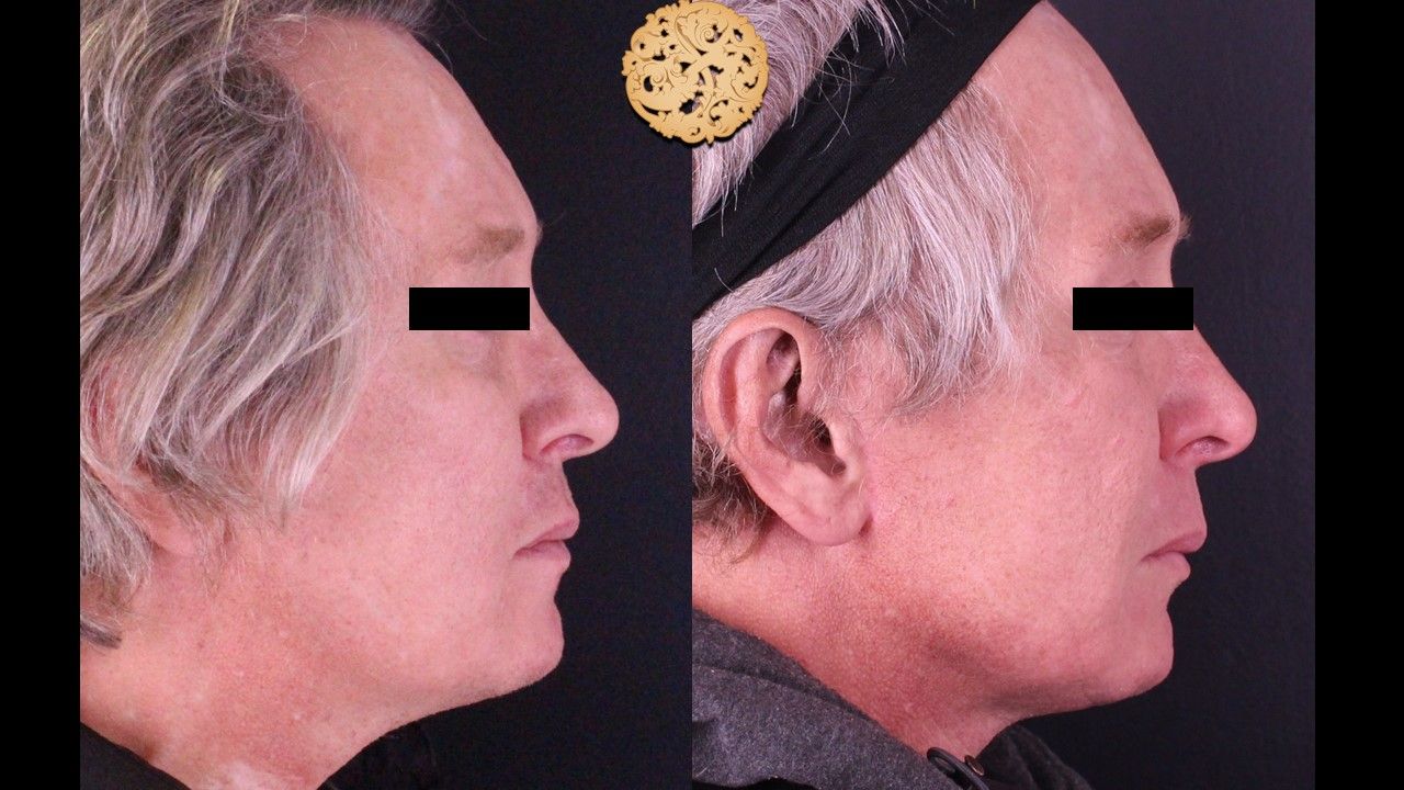 Facelift Neck Lift Before & After