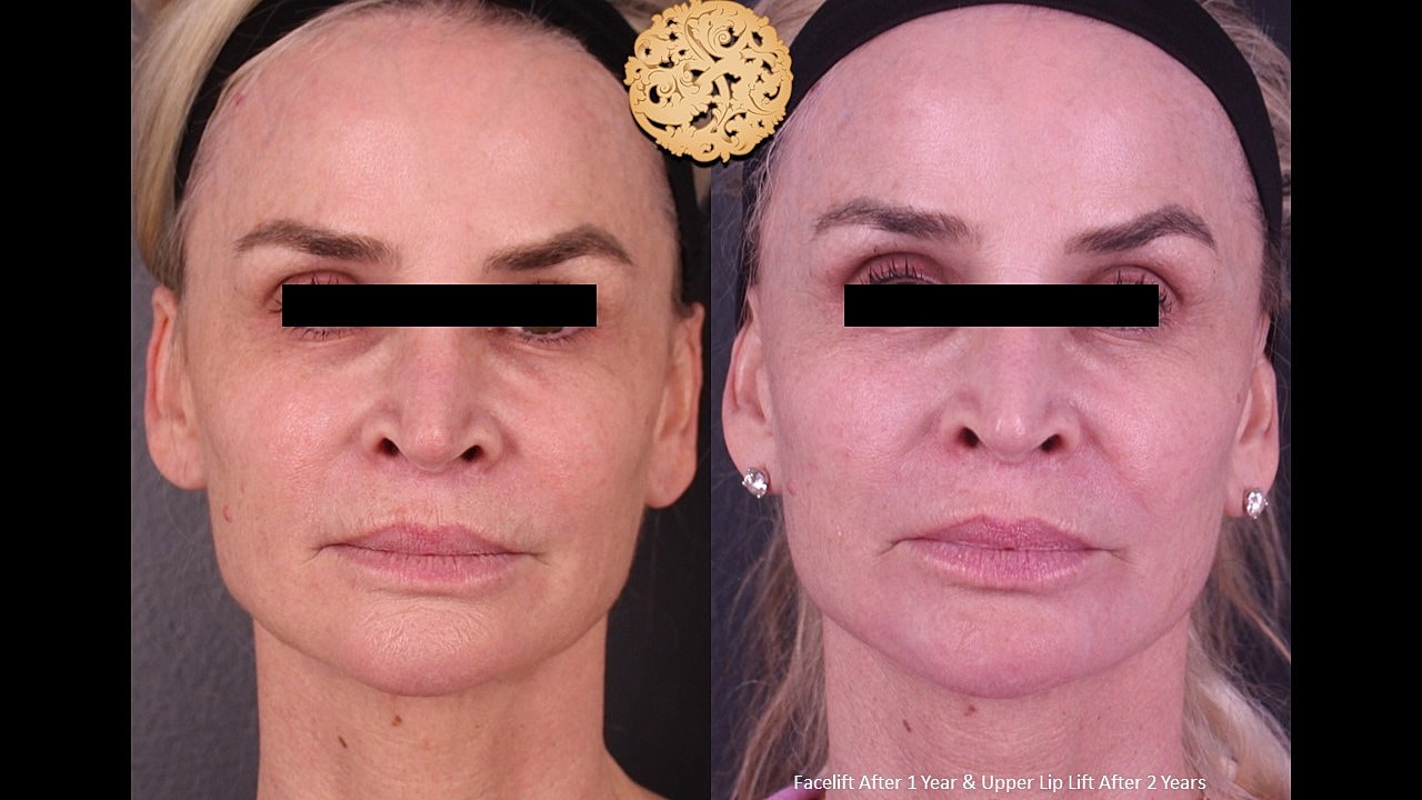 Facelift Neck Lift Before & After