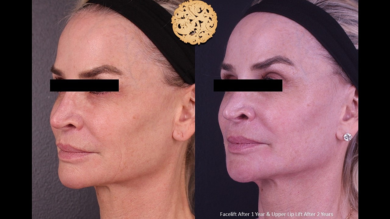 Facelift Neck Lift Before & After