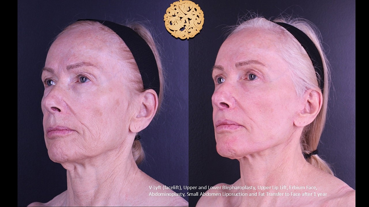 Facelift Neck Lift Before & After