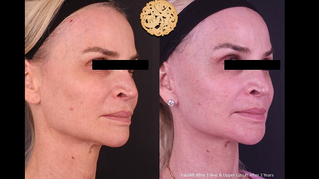 Facelift Neck Lift Before & After