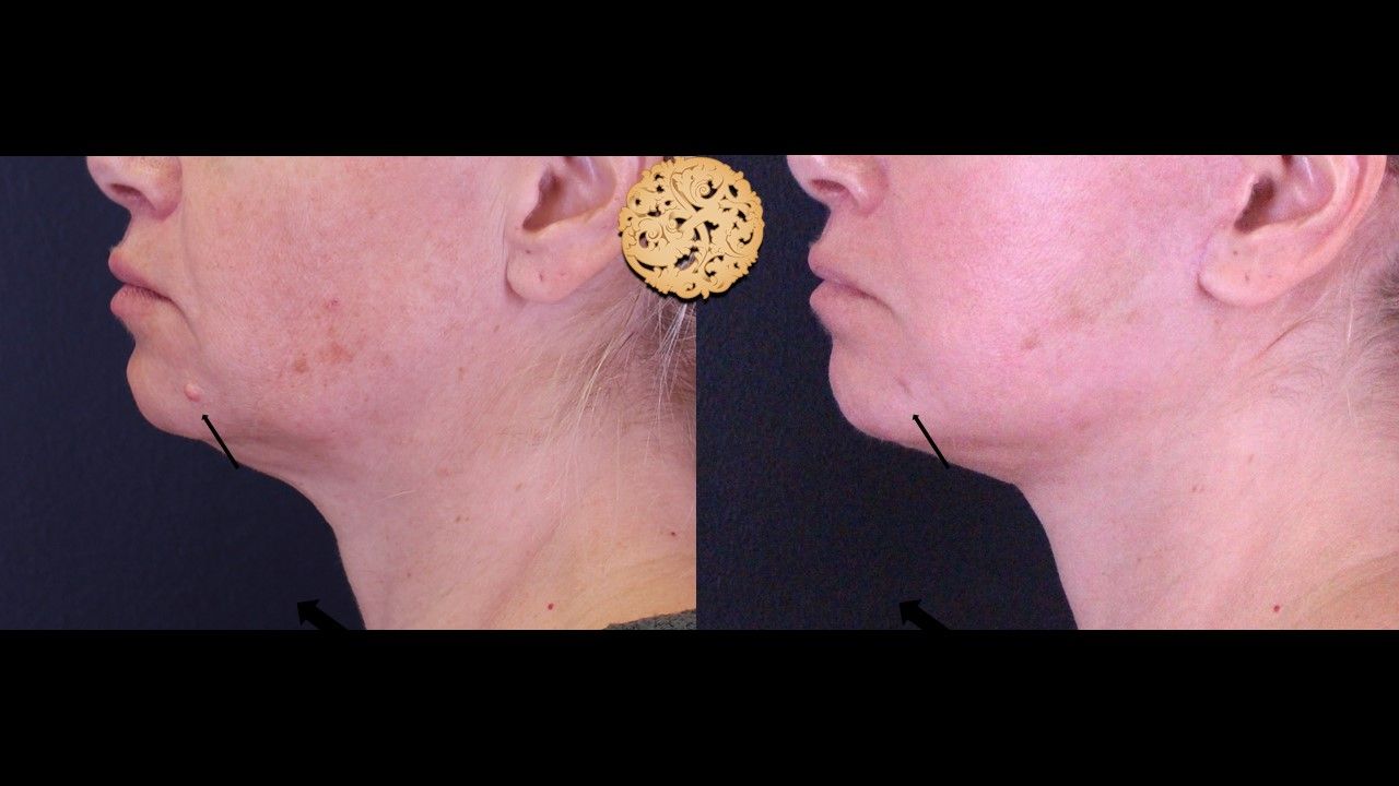 Mole Keloid Removal Before & After