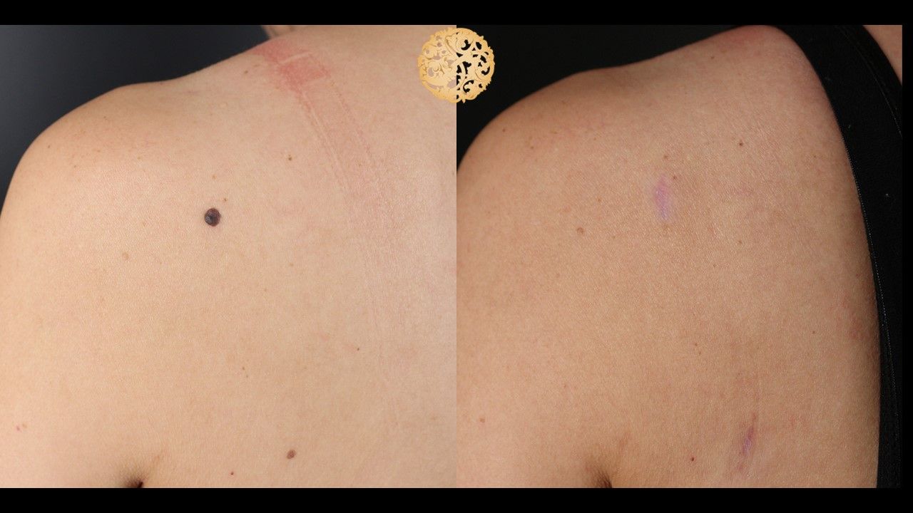 Mole Keloid Removal Before & After