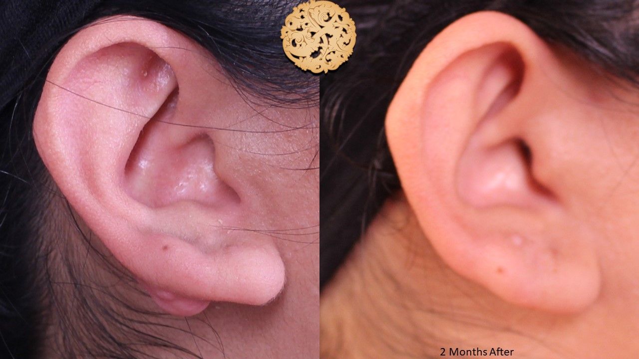 Mole Keloid Removal Before & After