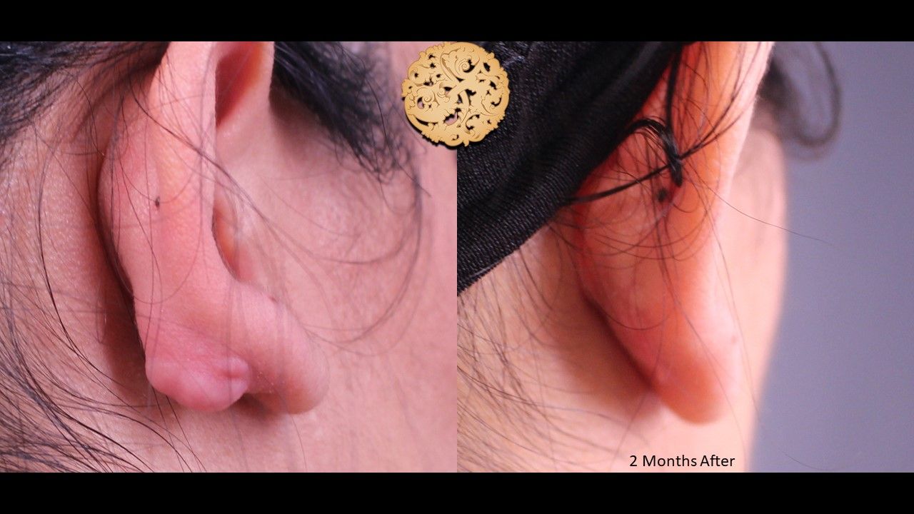 Mole Keloid Removal Before & After