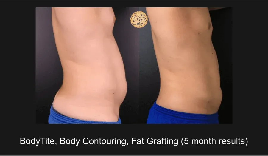 Facial Fat Transfer Before & After