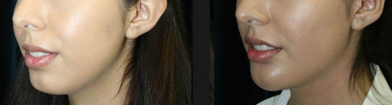 Chin Implant Before & After