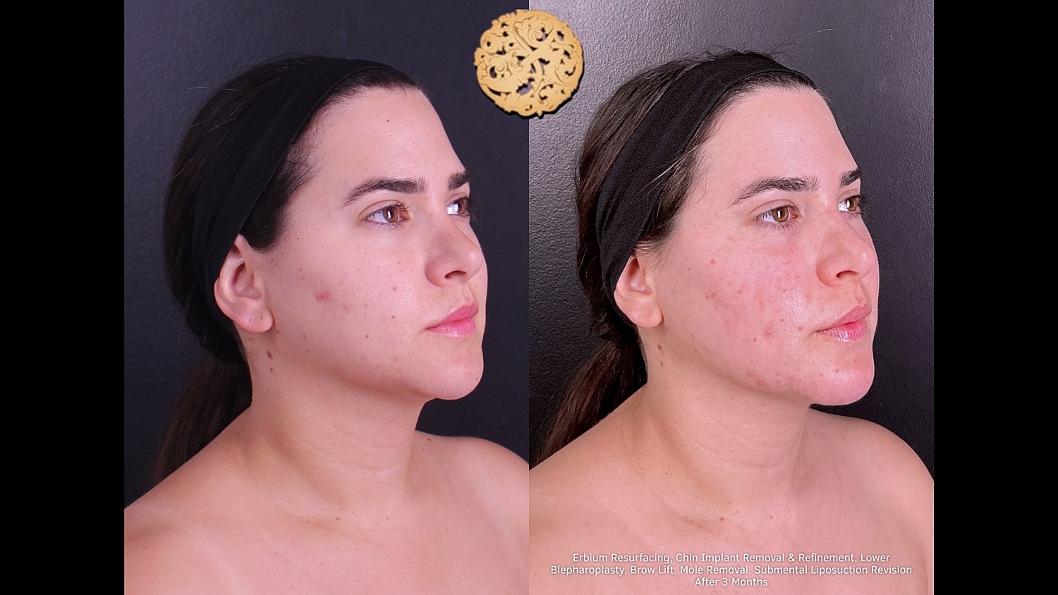 Erbium Resurfacing, Chin-Implant Removal/ Refinement, Lower Blepharoplasty, BrowLift, Mole Removal, Submental Liposuction Revision 3 months 