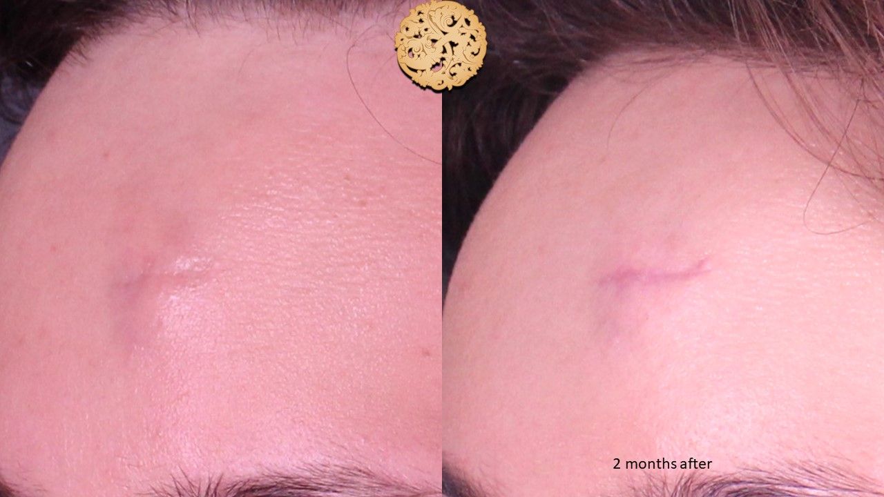 Scar Treatment Before & After