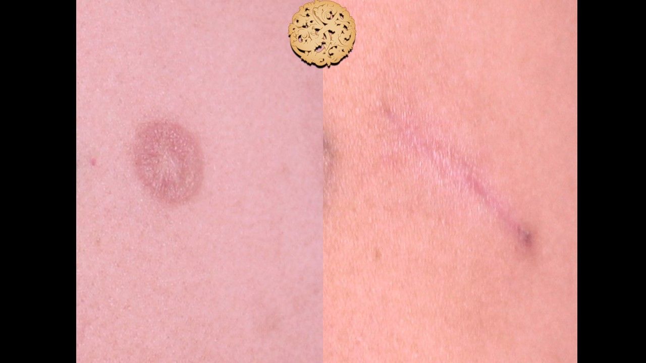 Scar Treatment Before & After