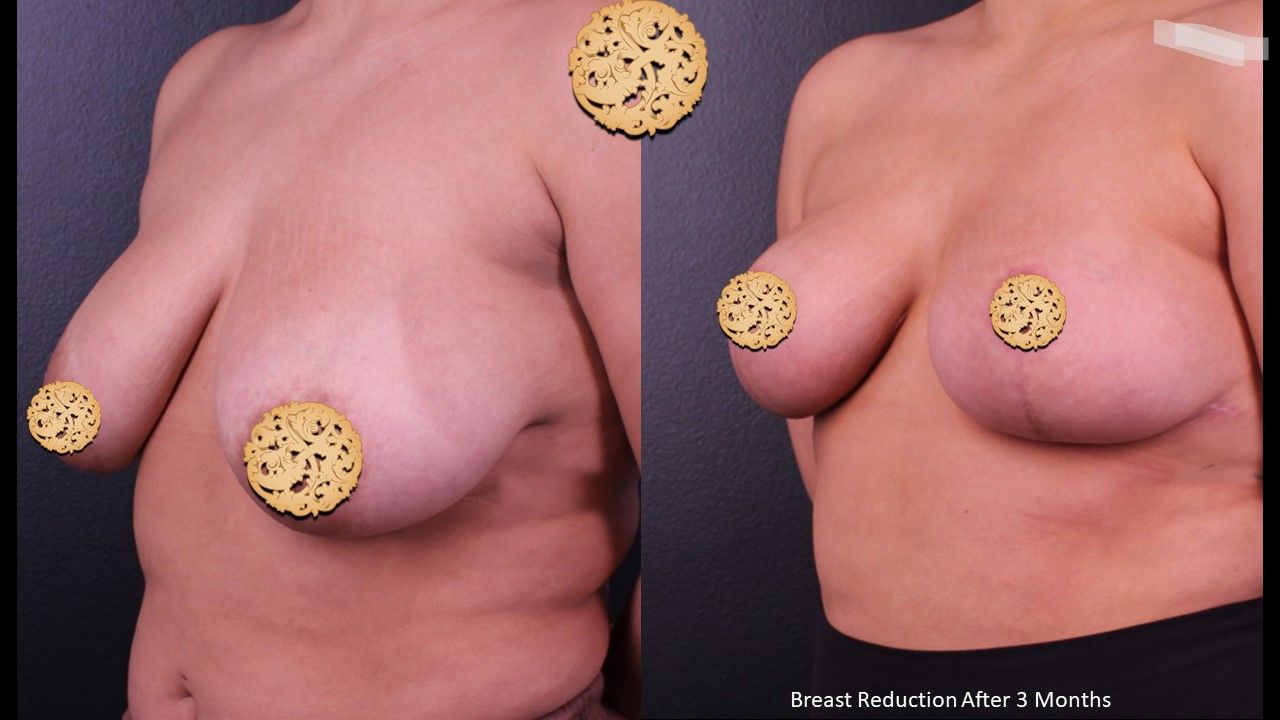 Breast Reduction Before & After