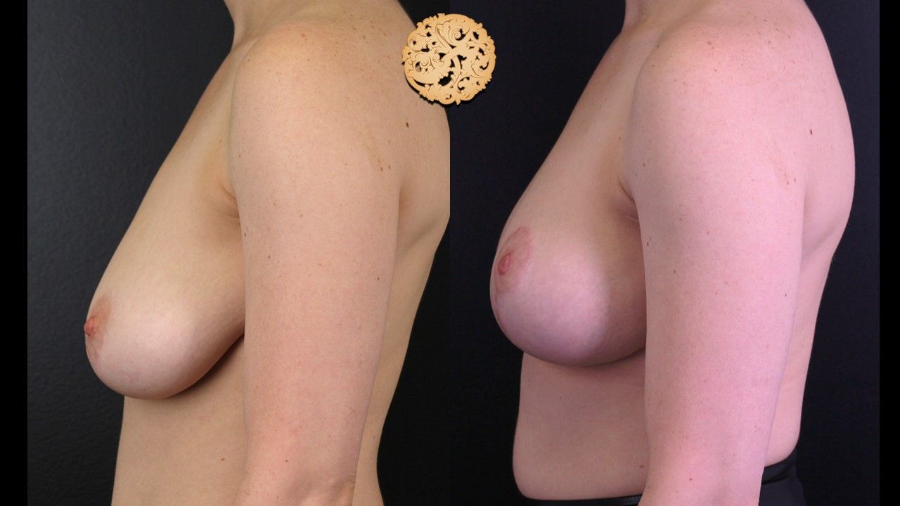 Breast Reduction Before & After