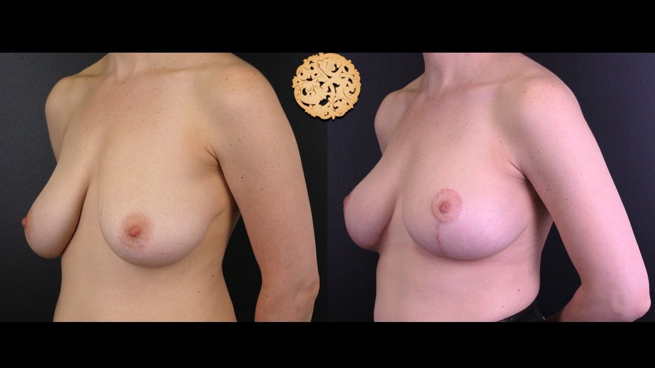 Breast Reduction Before & After