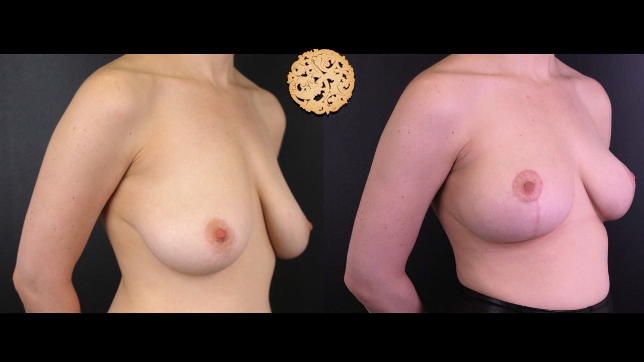 Breast Reduction Before & After