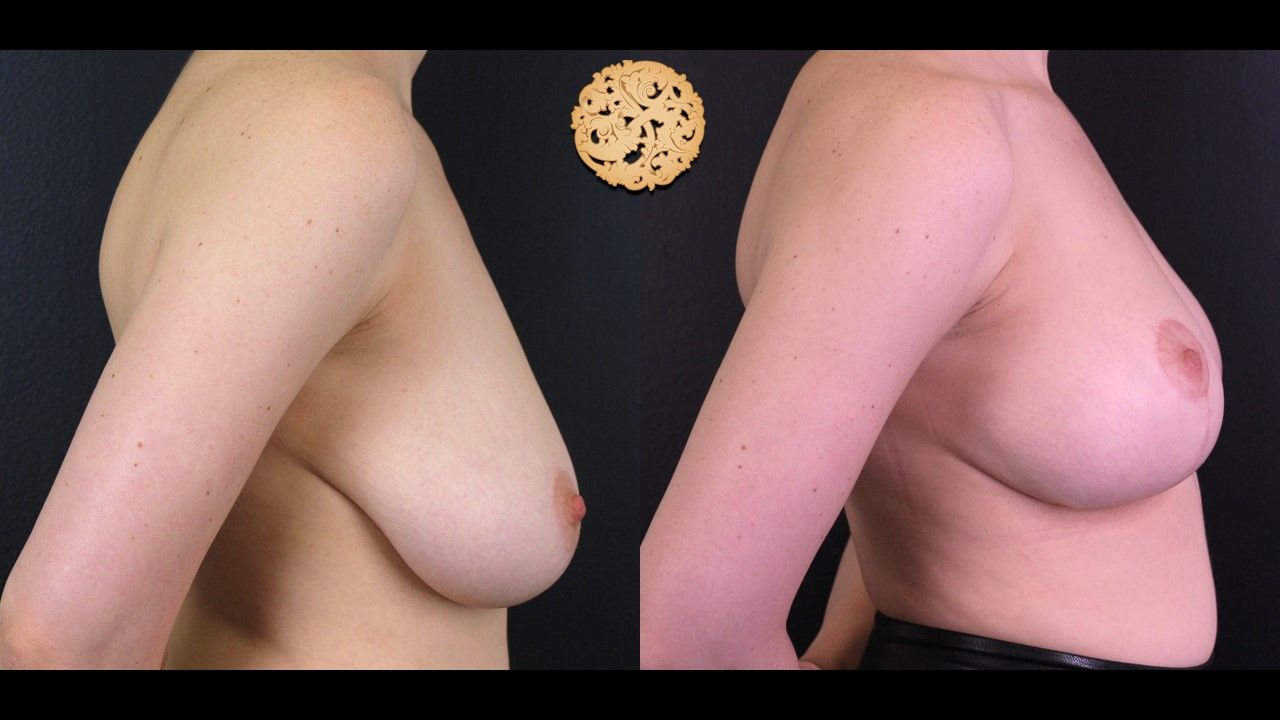 Breast Reduction Before & After