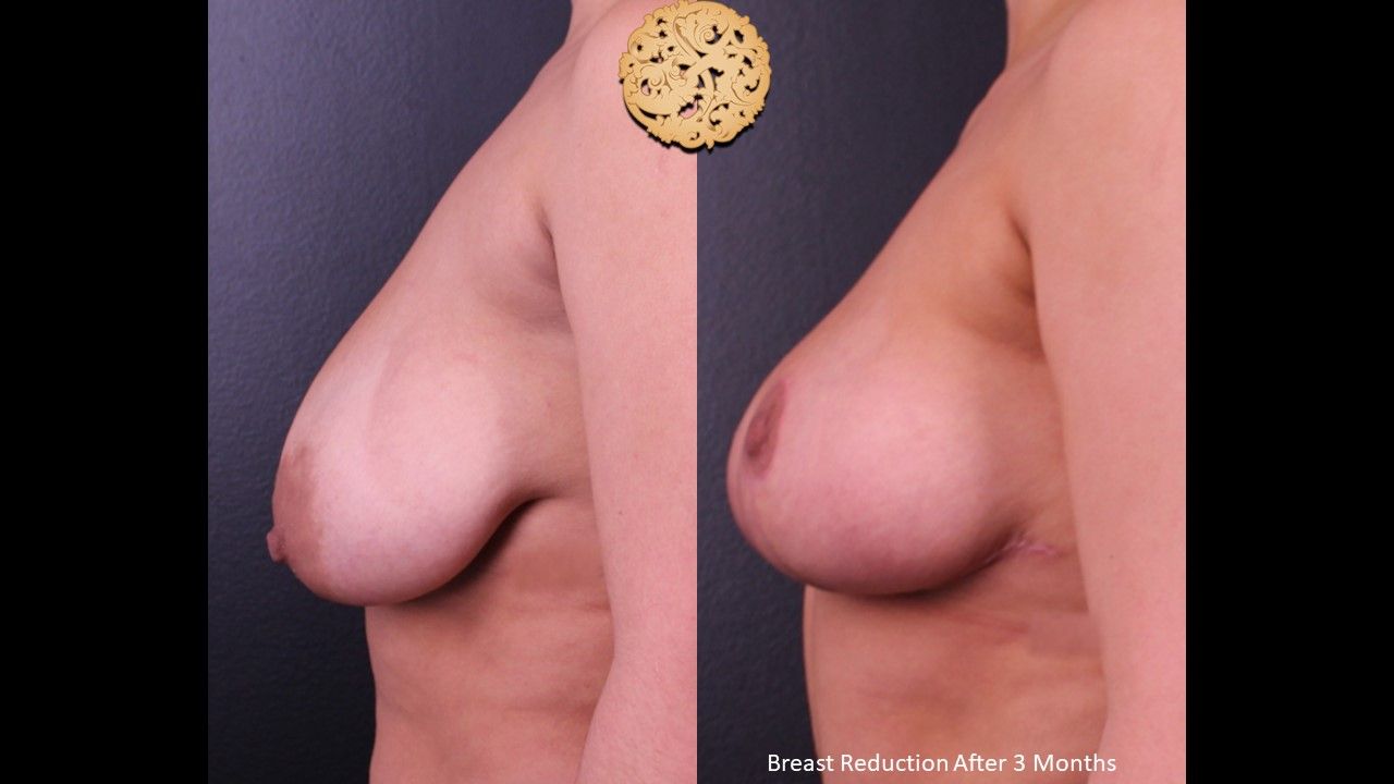 Breast Reduction Before & After