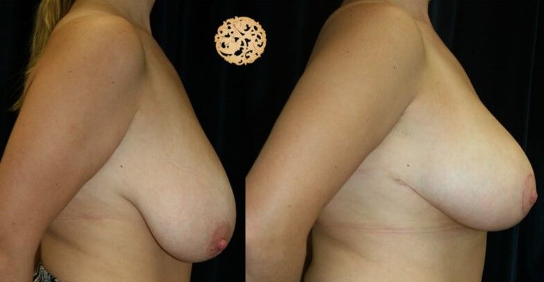 Breast Reduction Before & After