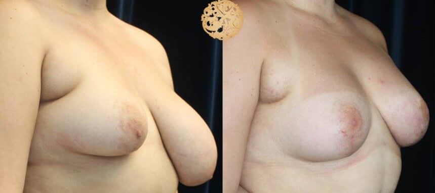 Breast Reduction Before & After
