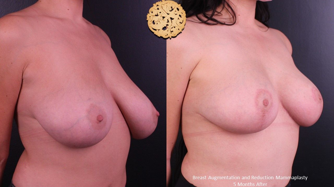 Breast Reduction Before & After