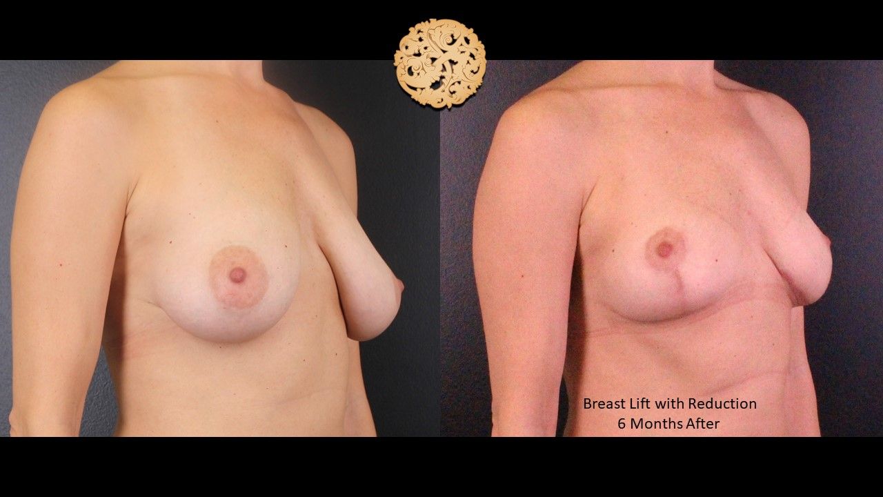Breast Reduction Before & After