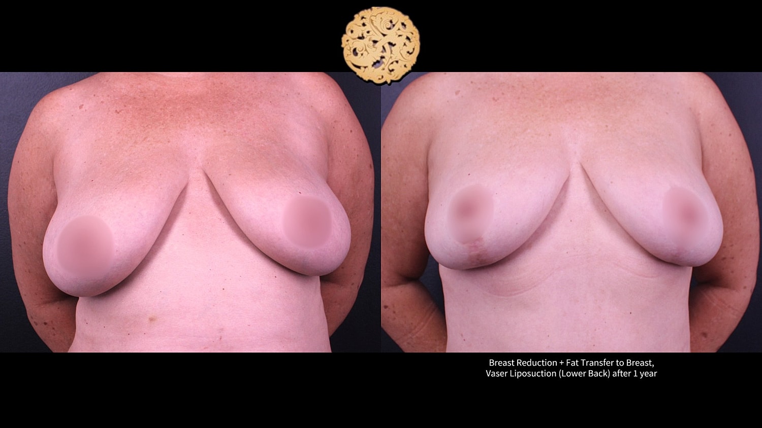 Breast Reduction + Fat Transfer to Breast, Vaser Liposuction (Lower Back) after 1 year