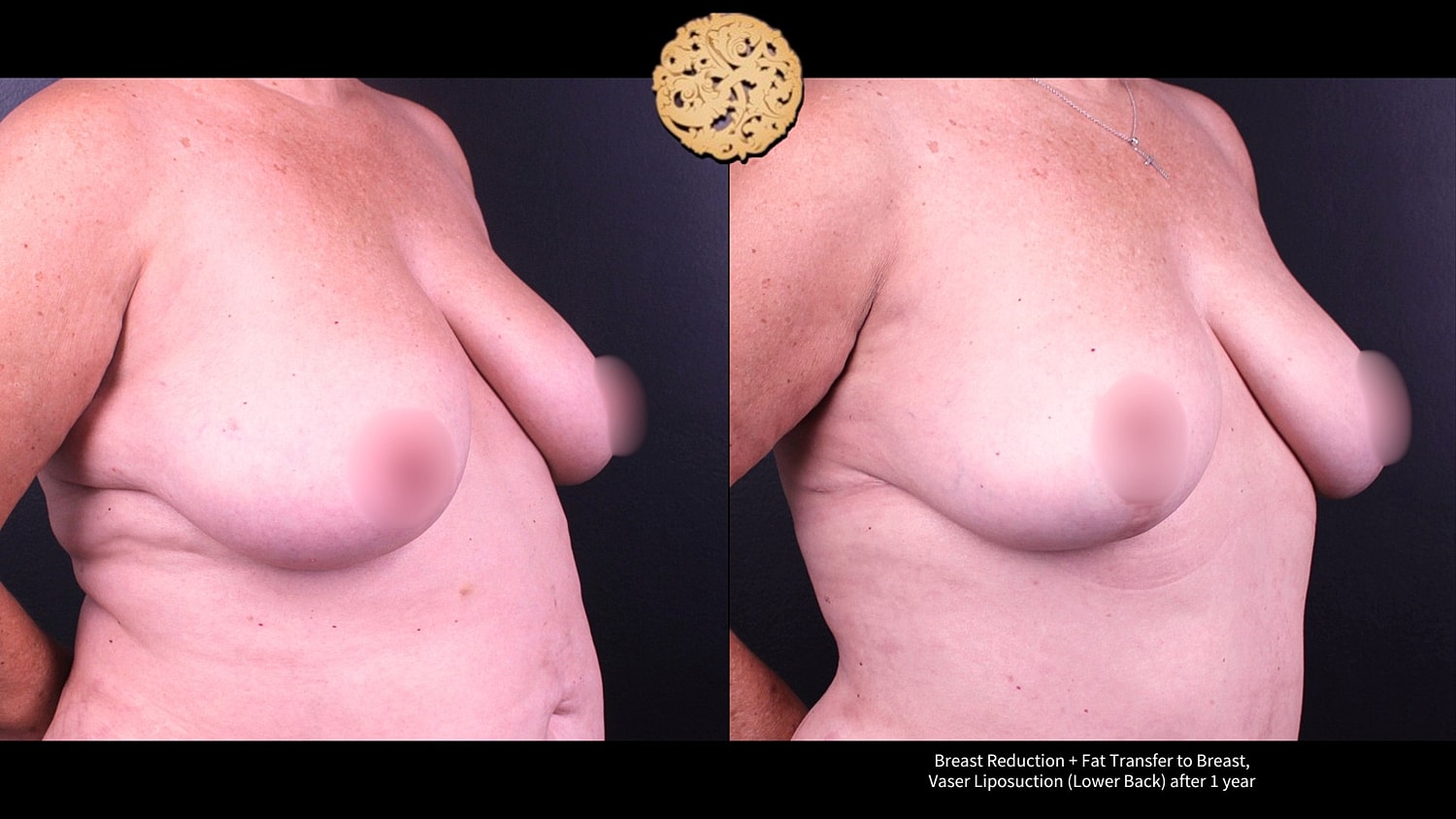 Breast Reduction + Fat Transfer to Breast, Vaser Liposuction (Lower Back) after 1 year