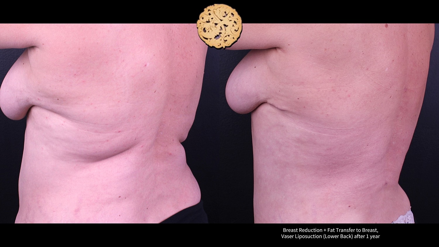 Breast Reduction + Fat Transfer to Breast, Vaser Liposuction (Lower Back) after 1 year