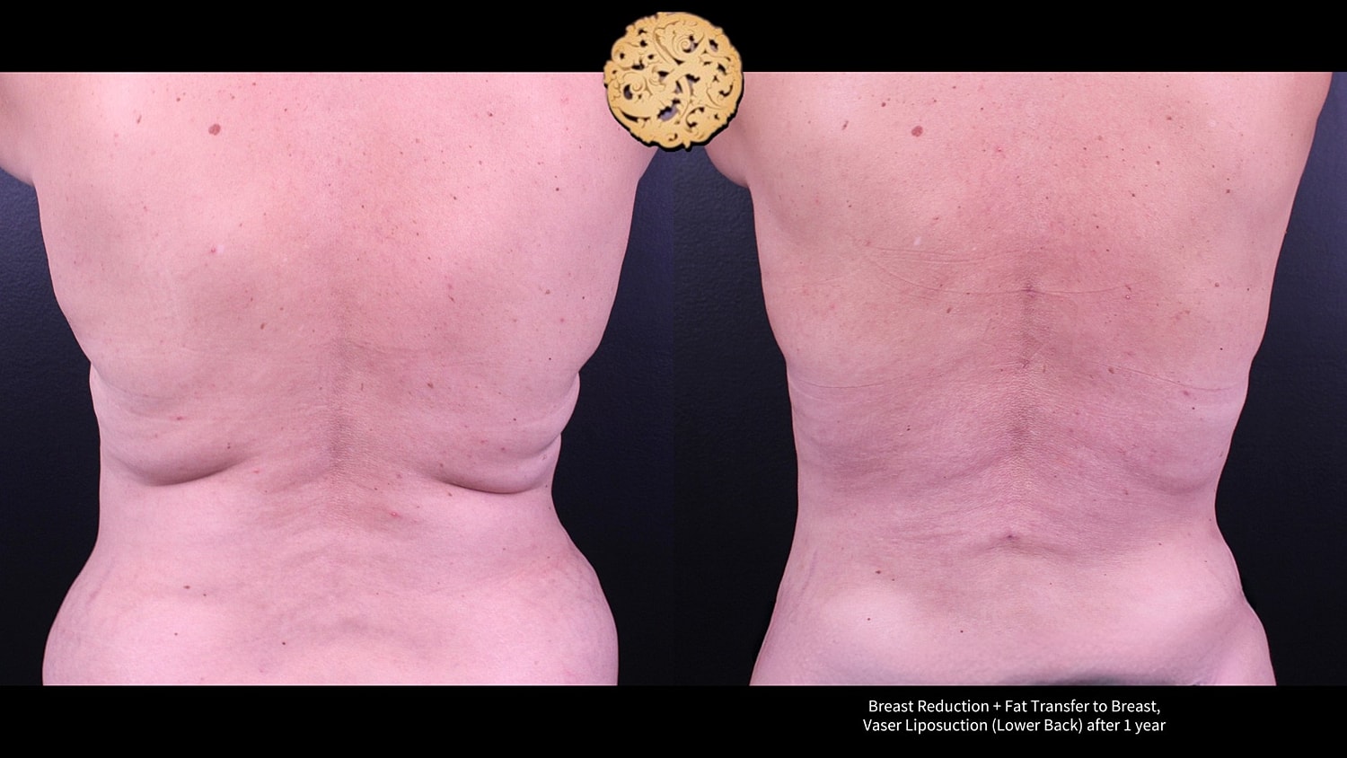 Breast Reduction + Fat Transfer to Breast, Vaser Liposuction (Lower Back) after 1 year