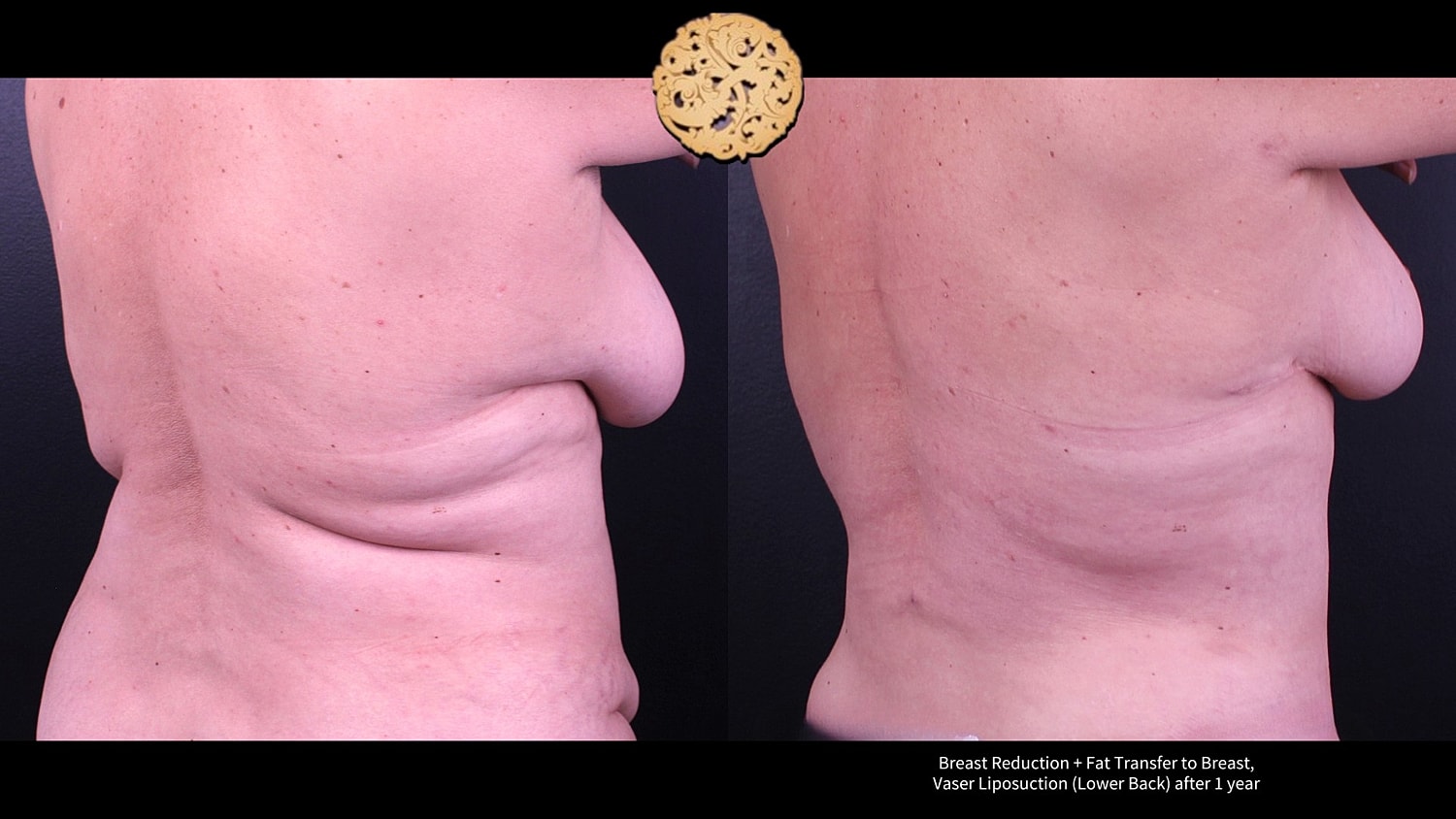 Breast Reduction + Fat Transfer to Breast, Vaser Liposuction (Lower Back) after 1 year