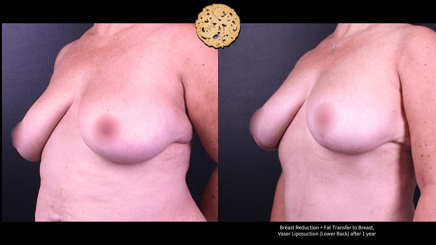 Breast Reduction + Fat Transfer to Breast, Vaser Liposuction (Lower Back) after 1 year