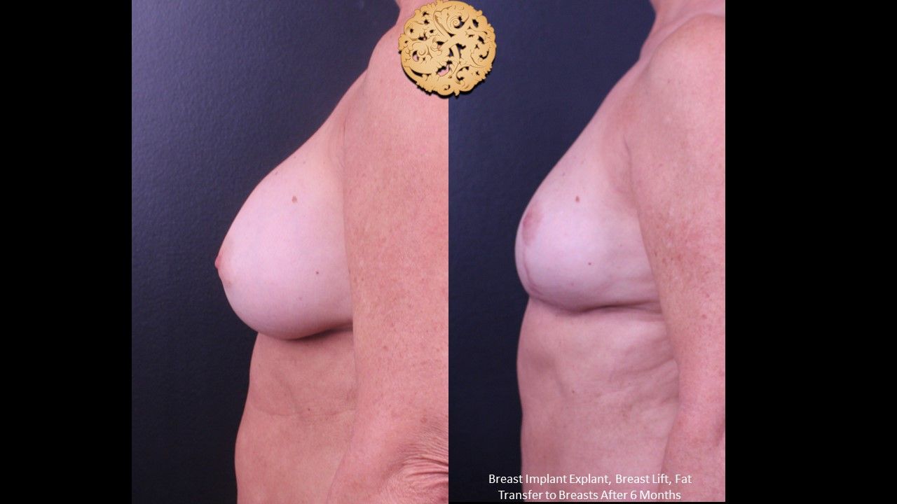 Breast Lift Before & After
