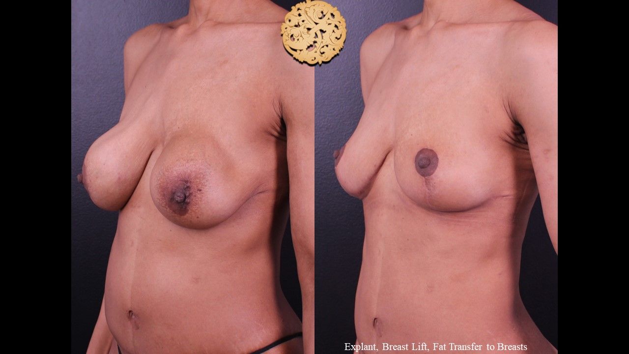 Breast Lift Before & After