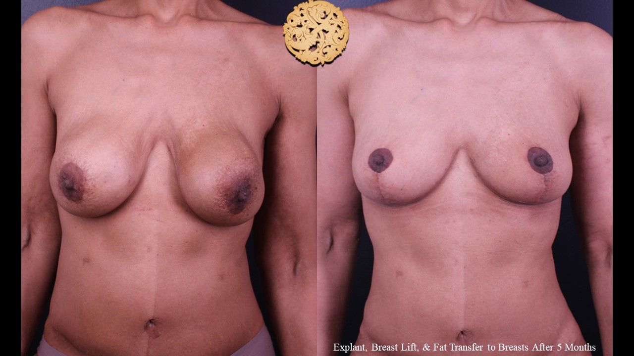 Breast Lift Before & After