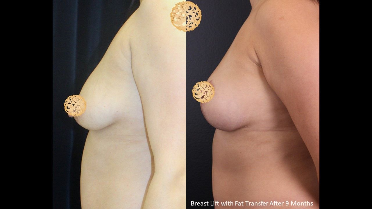 Breast Lift Before & After