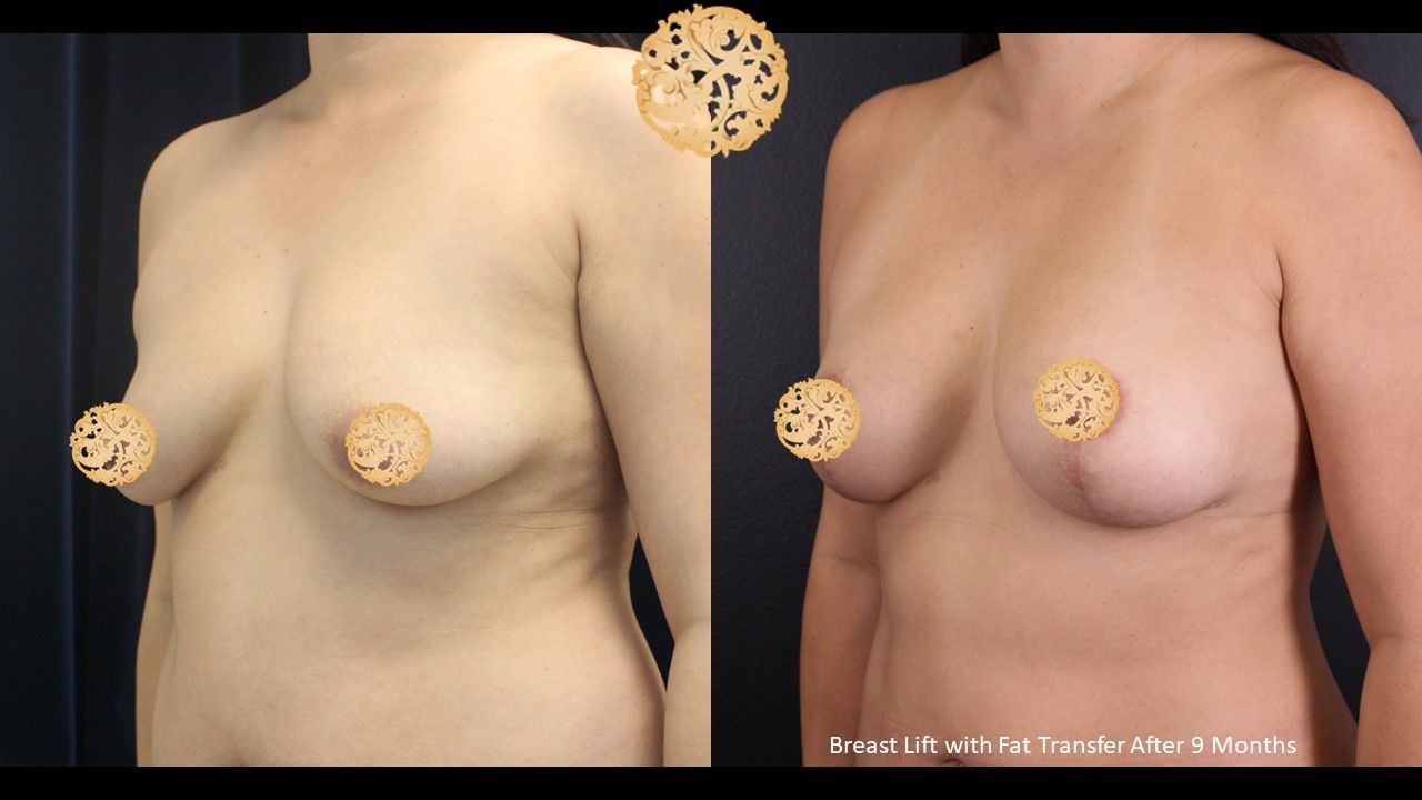 Breast Lift Before & After