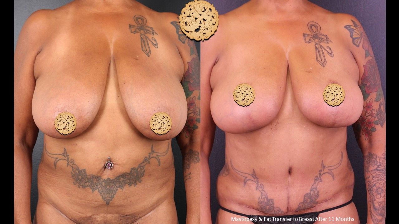 Breast Lift Before & After