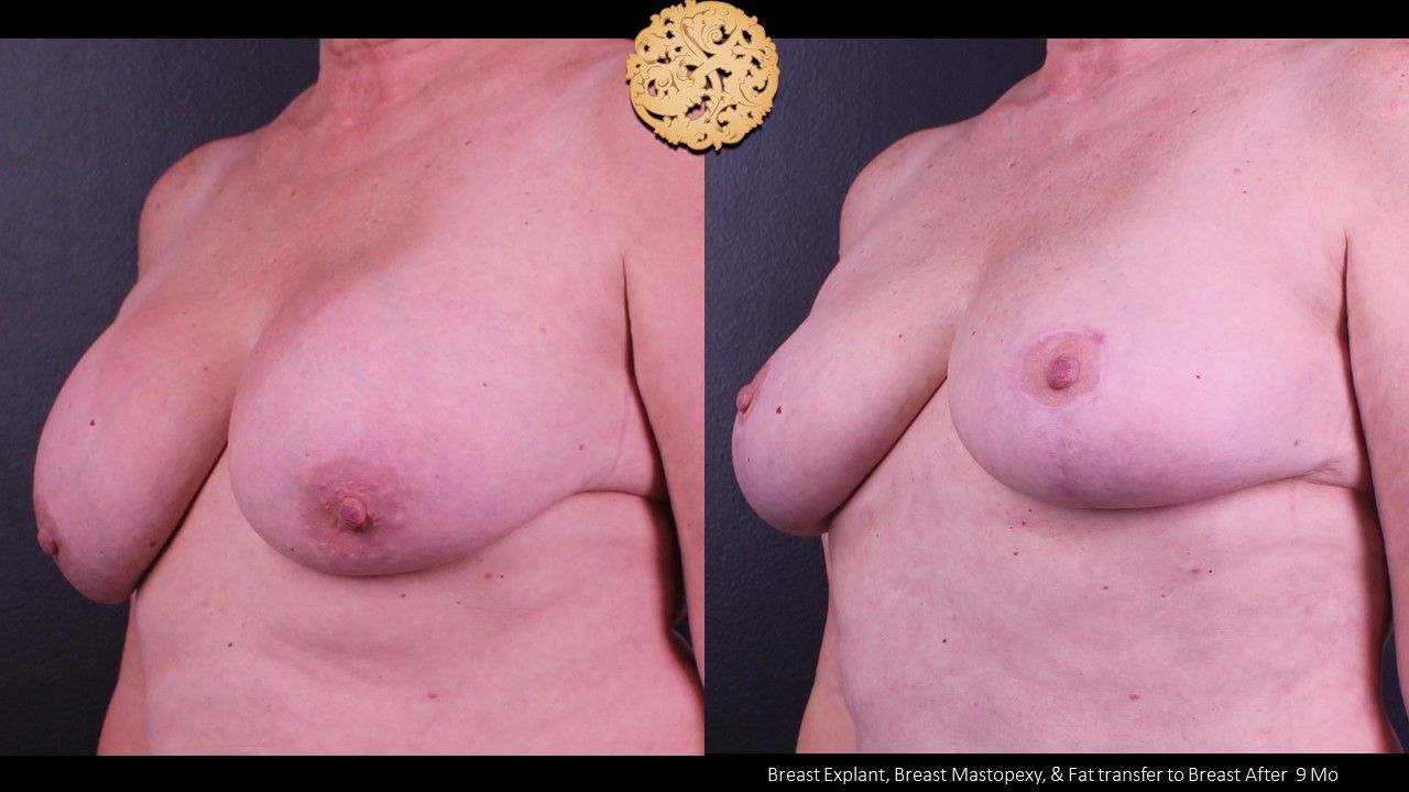 Breast Lift Before & After