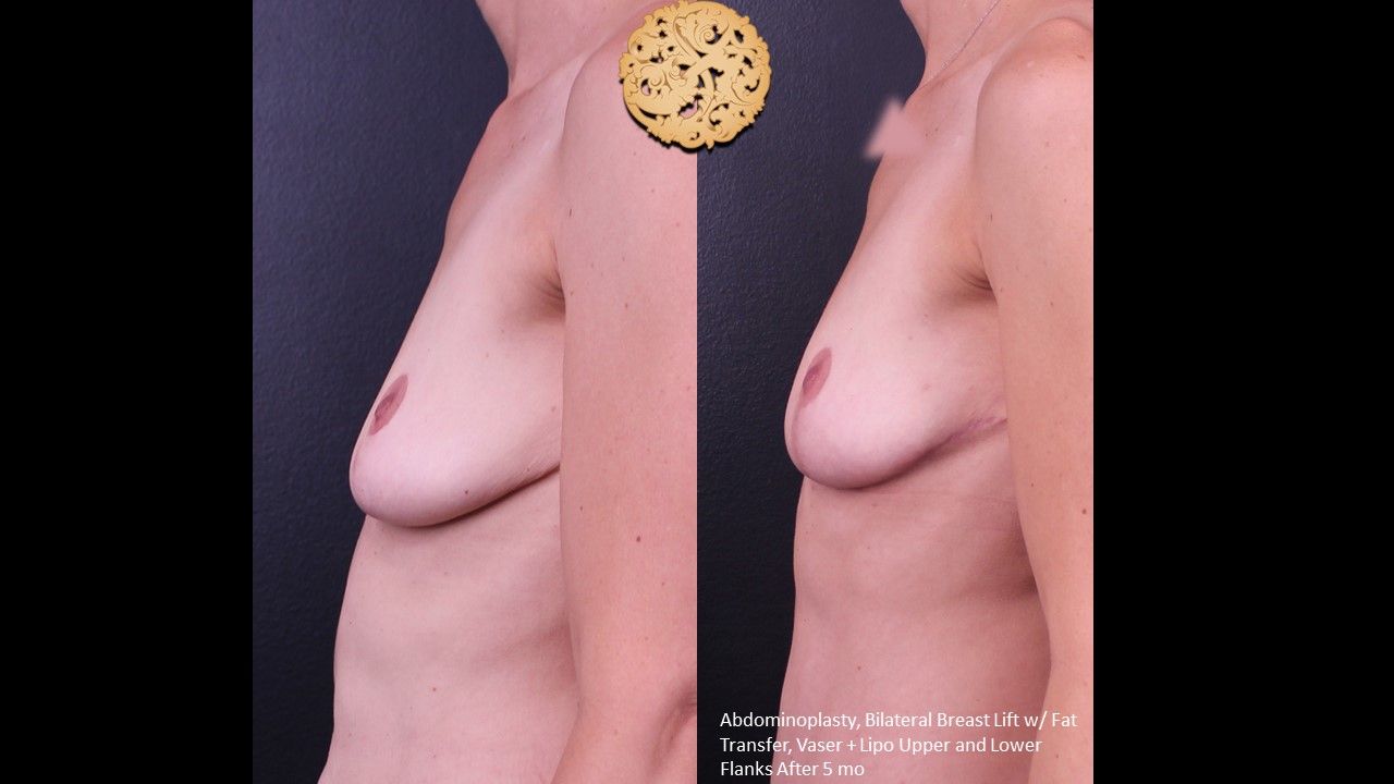 Breast Lift Before & After