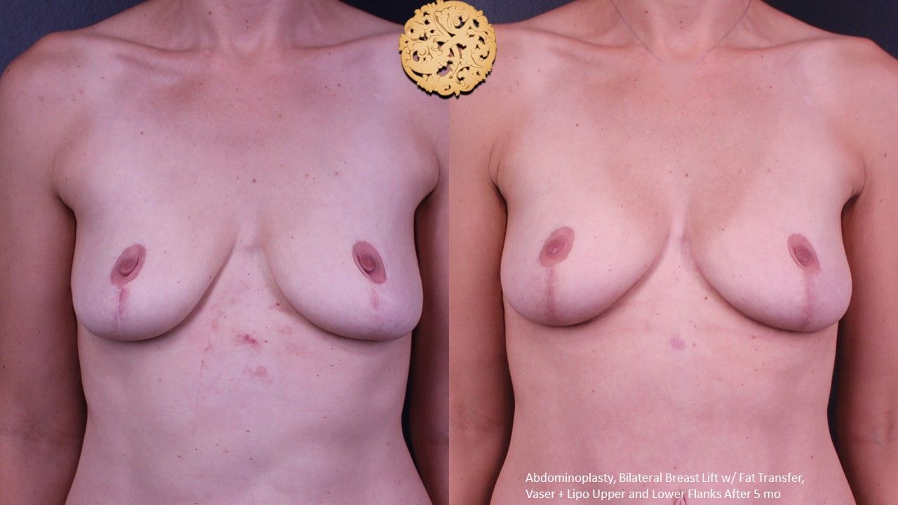 Breast Lift Before & After