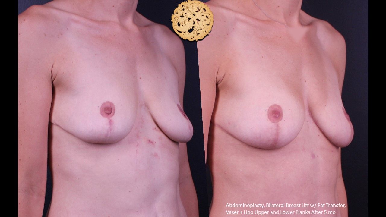 Breast Lift Before & After