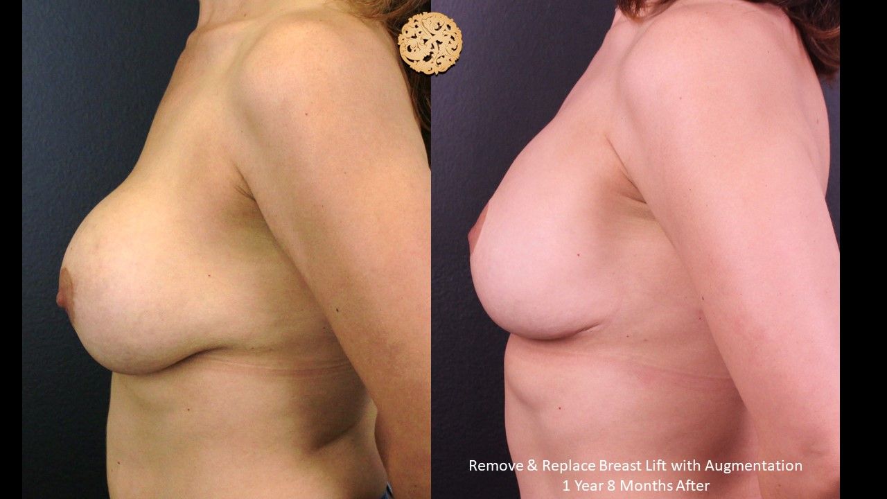 Breast Lift Before & After