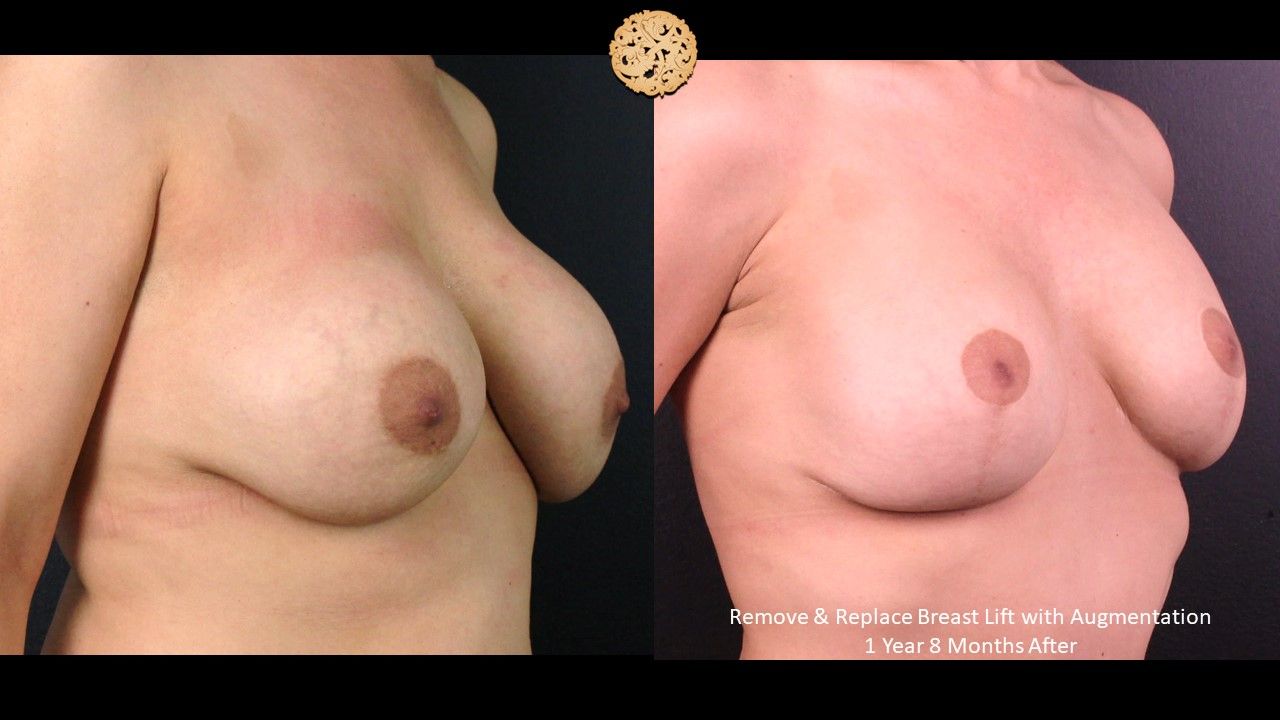 Breast Lift Before & After
