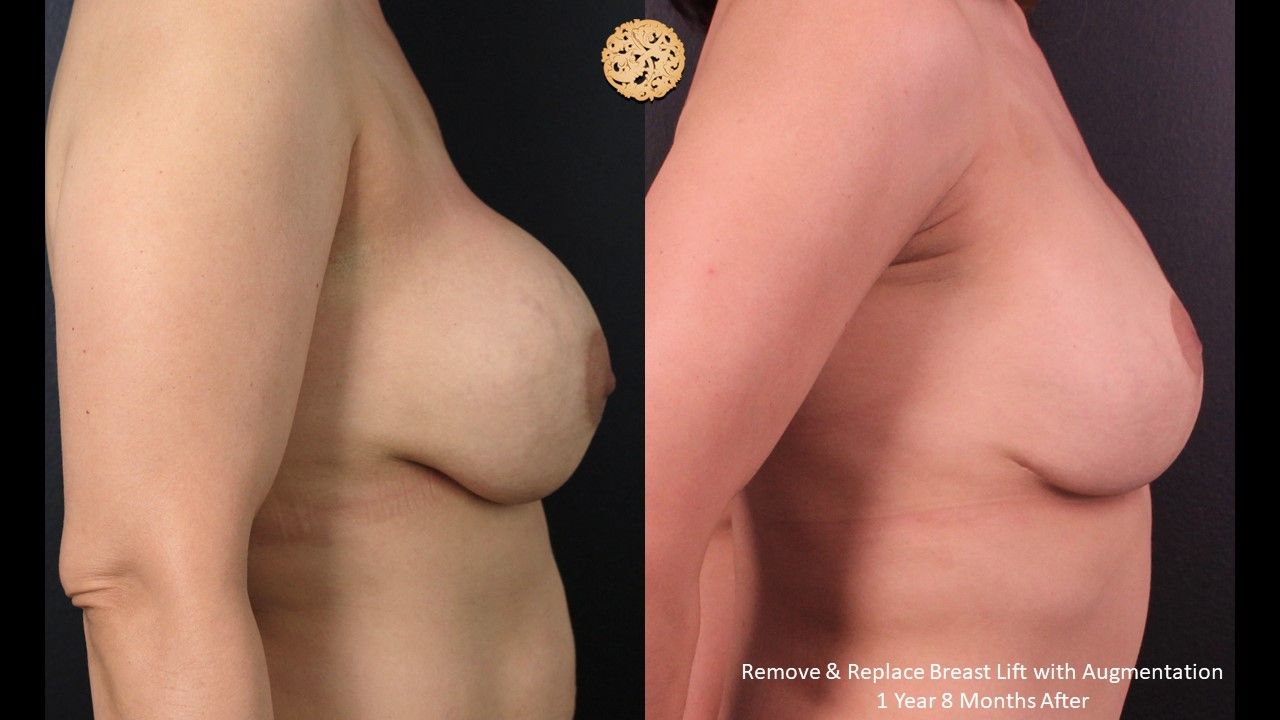 Breast Lift Before & After