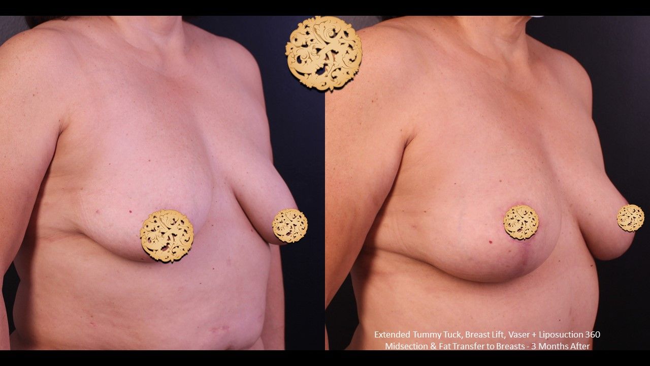 Breast Lift Before & After