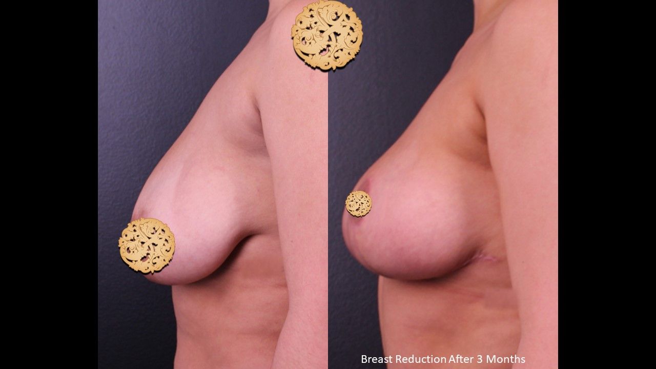 Breast Lift Before & After