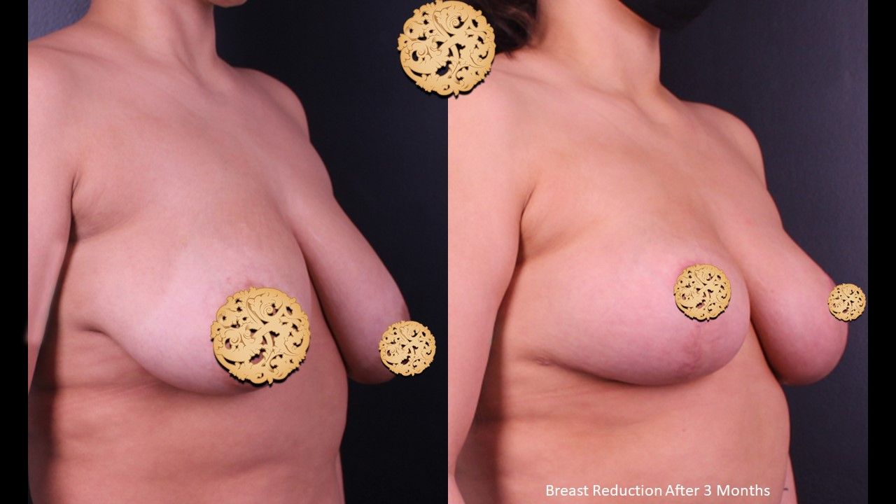Breast Lift Before & After