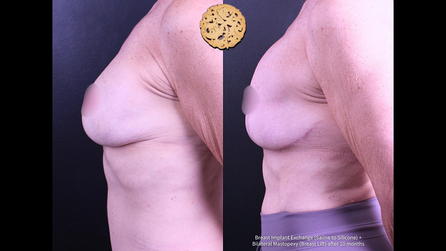 Breast implant exchange and lift before and after.