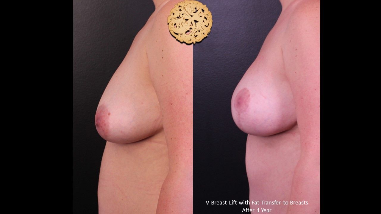 Breast Lift Before & After