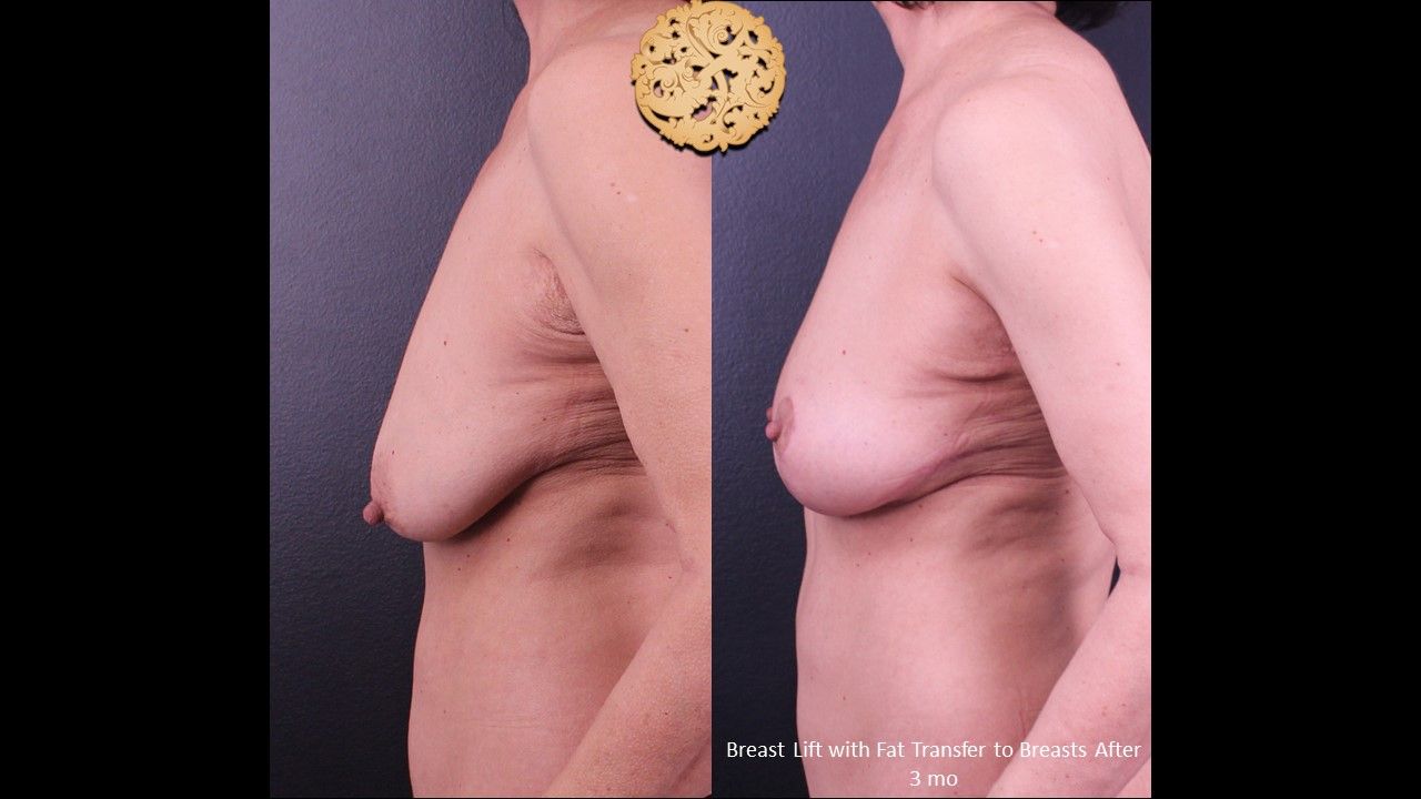 Breast Lift Before & After